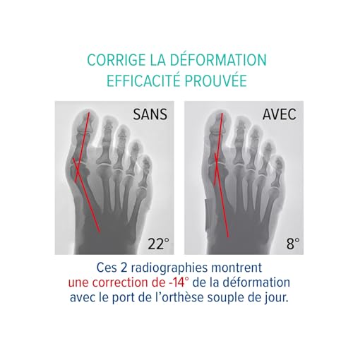 Epitact - Hallux Valgus (Bunion) Day Corrector Foot Care Device